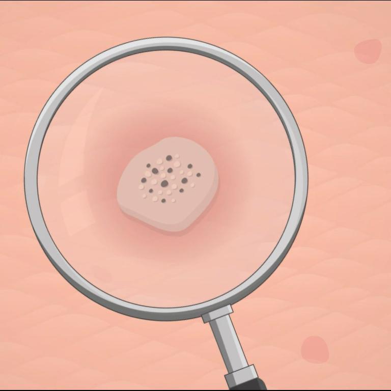 How To Get Rid Of Warts Editorji How To Get Rid Of Warts Editorji