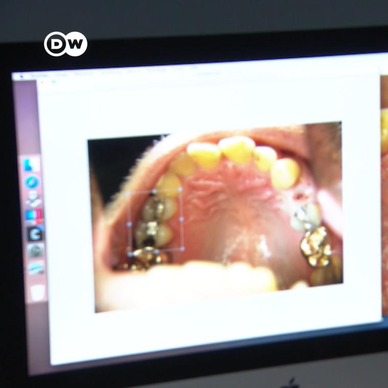 How toxic are amalgam fillings? Editorji